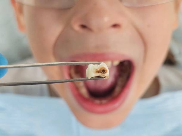 Best Dental Abscess Treatment in New London, CT
